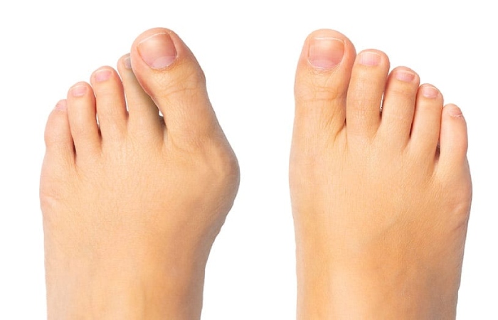 Different Types of Lapiplasty Bunion Surgery