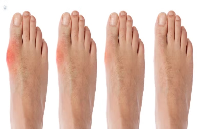 How is the Bunion Operation_