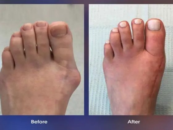 Lapiplasty Bunion Surgery