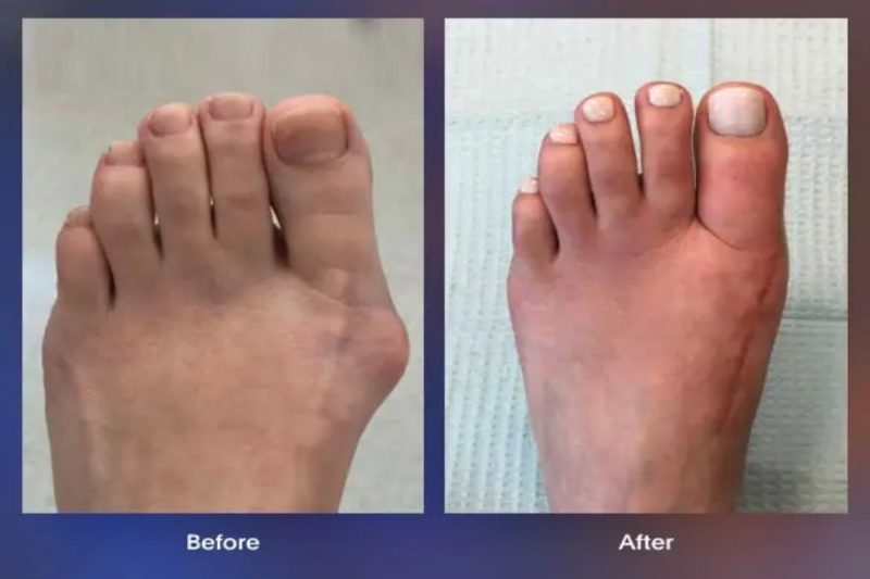 Lapiplasty Bunion Surgery