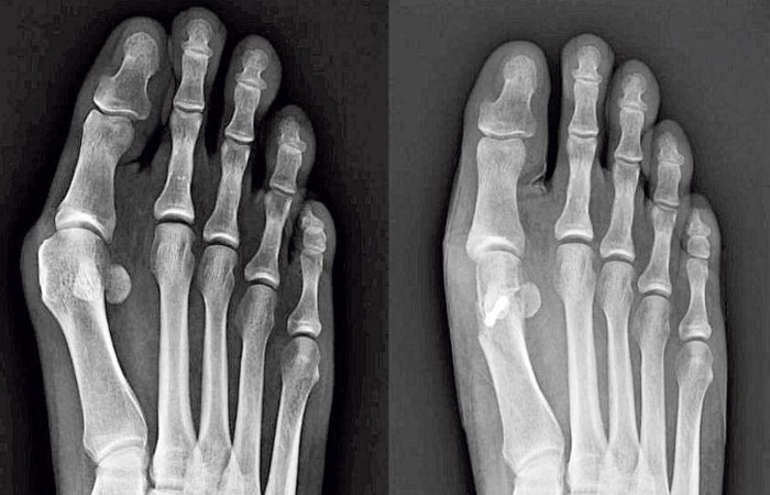 Risks of the Procedure